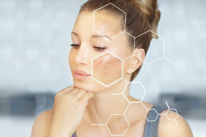 Pigmentfoltok – Miért alakulnak ki és hogyan kezelheted őket?