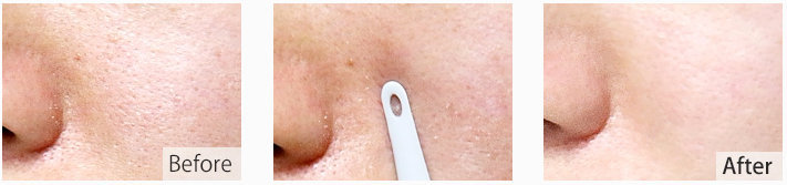 So Natural gyengéd mitesszer eltávolító mitesszerkinyomás So Natural gyengéd mitesszer eltávolító mitesszerkinyomás